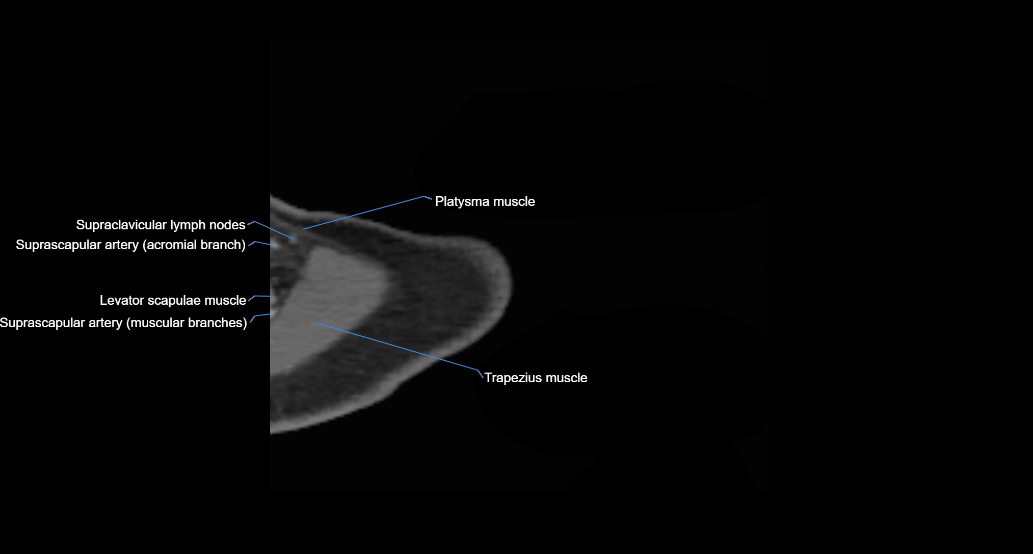 CT Shoulder axial cross sectional anatomy labelled radiology image -00003.webp